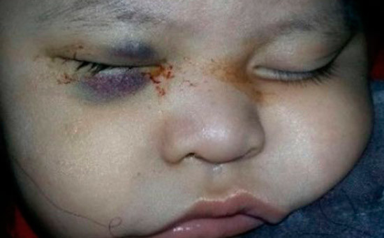 Mamás hacen frente contra médico del IMSS que afectó ojos de 2 niños