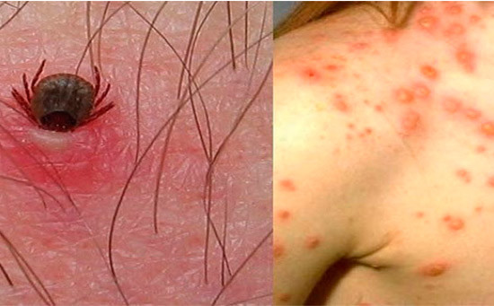 Autoridades sanitarias reportaron el primer caso de rickettsia grave en Tijuana