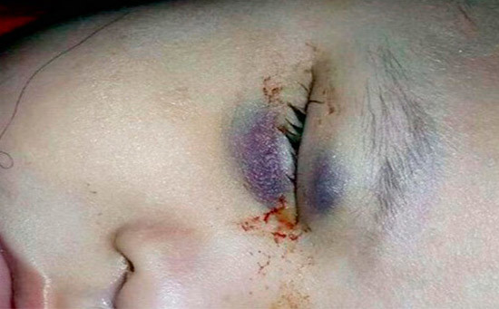 Extirpan por error ojo sano a niño en IMSS de Sonora